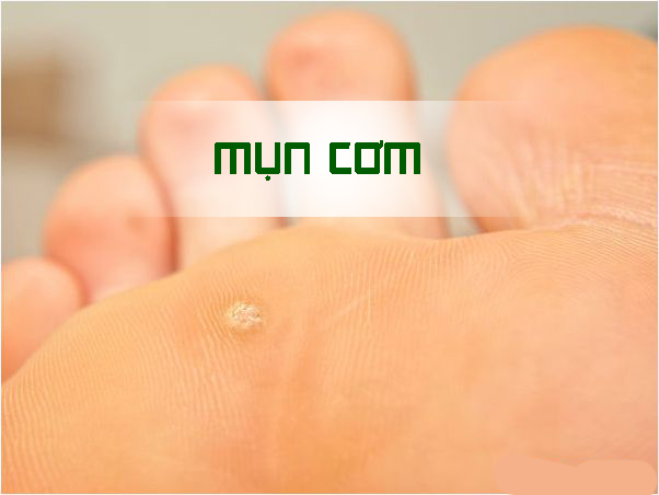 Đánh bay mụn cơm bằng các cách đơn giản