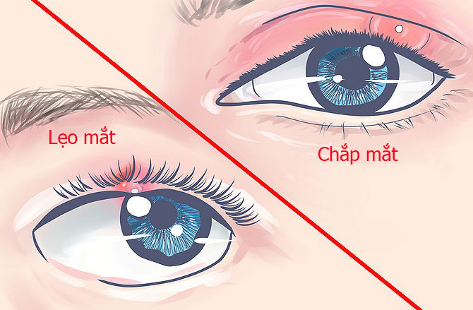 Nguyên nhân và biểu hiện của bệnh chắp, lẹo mắt