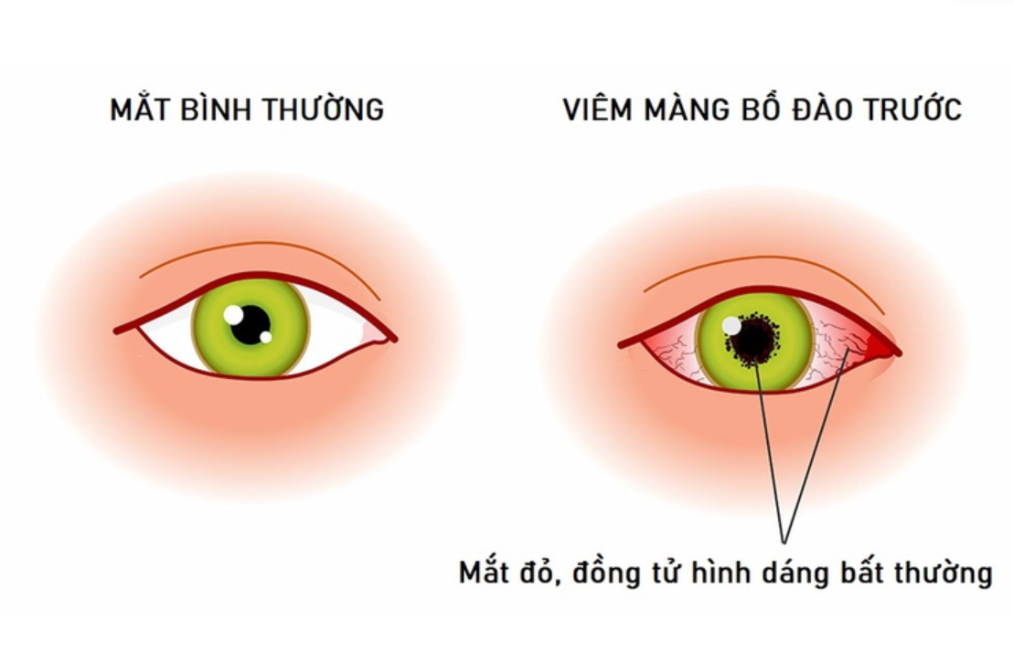 Nguyên nhân và yếu tố nguy cơ gây viêm màng bồ đào