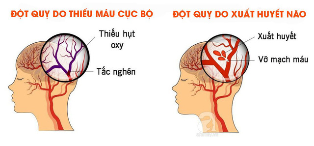 Phòng Ngừa Đột Quỵ Nhồi Máu Não, Bảo Vệ Não Bộ Và Nâng Cao Chất Lượng Cuộc Sống