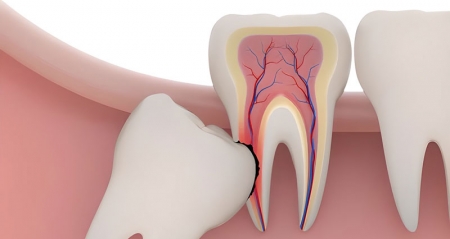 Nhổ răng khôn tại Bệnh viện Đa khoa Khu vực Thủ Đức có được hưởng BHYT?